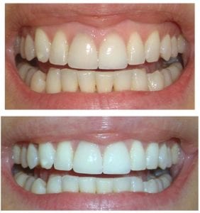 professional teeth whitening in anchorage mint dental alaska