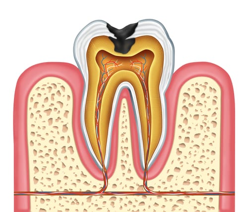 Endodontic Therapy