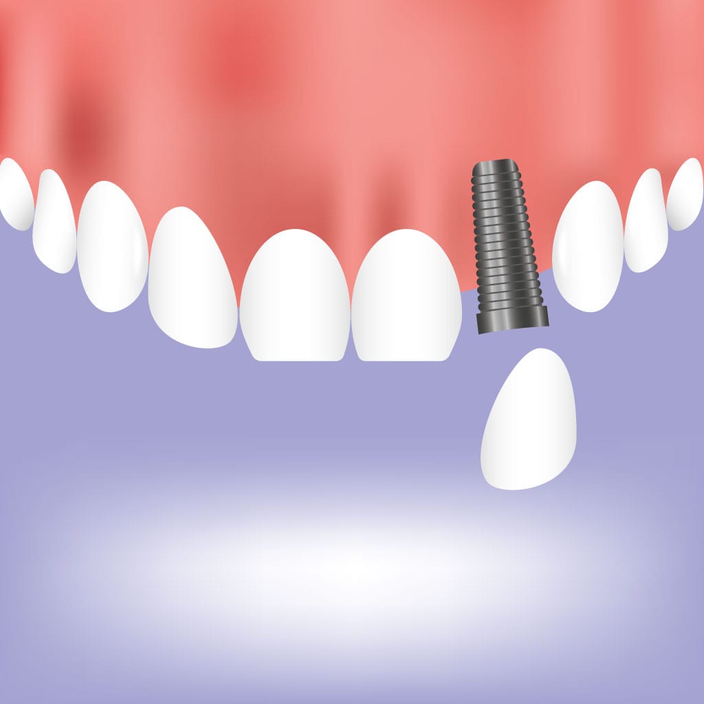 Dental Implants In Anchorage Mint Dental Alaska