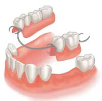partial denture