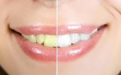 Teeth whitening results