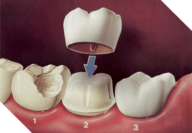 A dental crown is placed over a cracked tooth in this illustration.