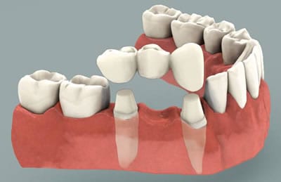An illustration shows how a dental bridge is implanted in the mouth. 