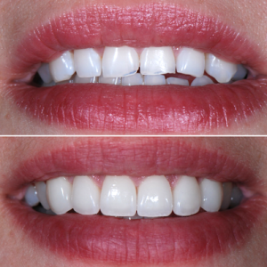 Porcelain Veneer results