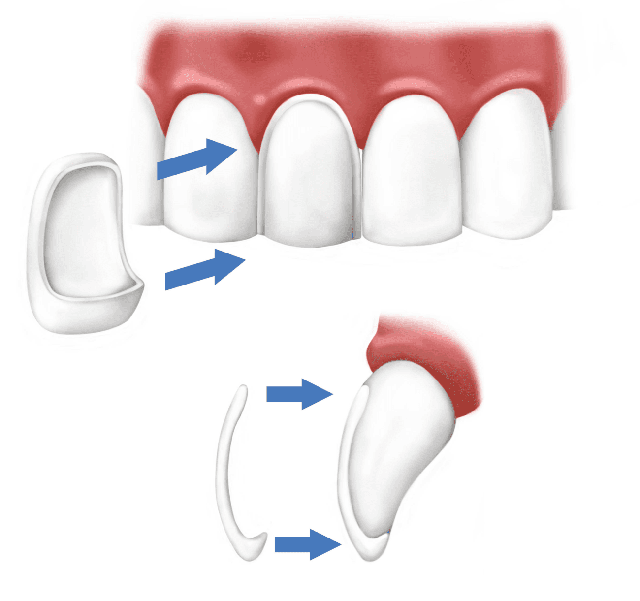 Porcelain Veneers