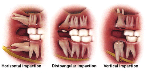 Three scenarios for wisdom teeth removal are illustrated. 