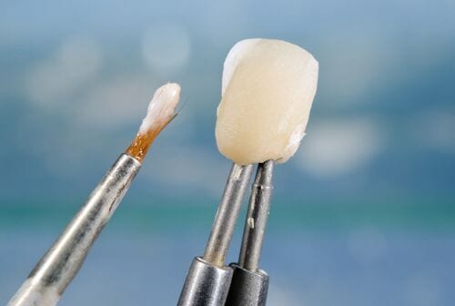 dental bonding in anchorage