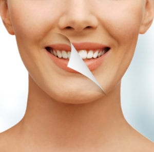 Can you Weaken your Teeth Through Whitening?