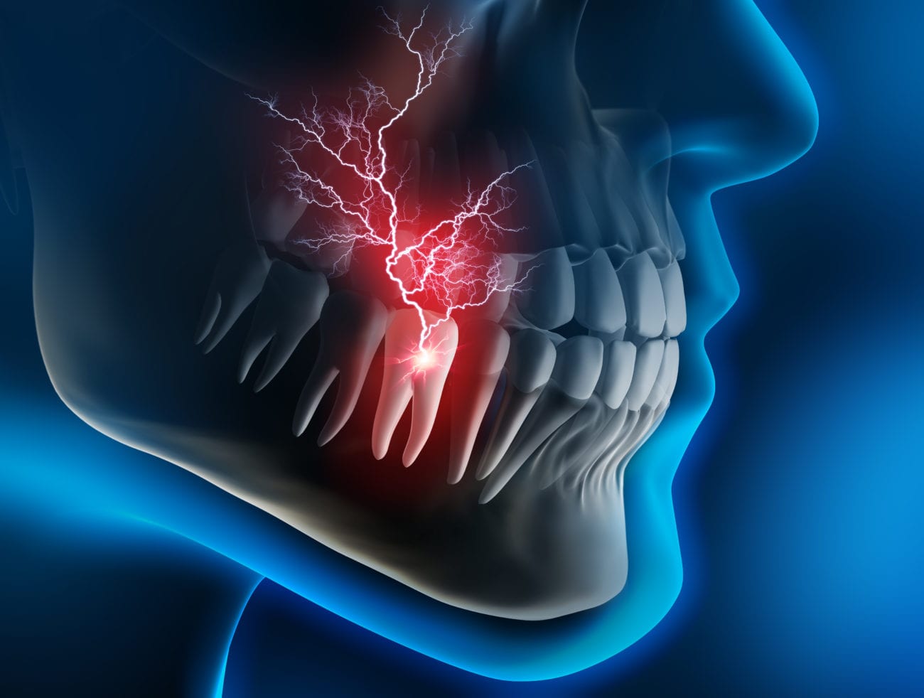 3-ways-to-ease-wisdom-tooth-pain-wikihow