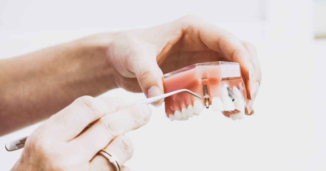 Dental implants Anchorage by Mint Dental