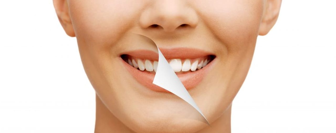 Anchorage Dentist Teeth Whitening