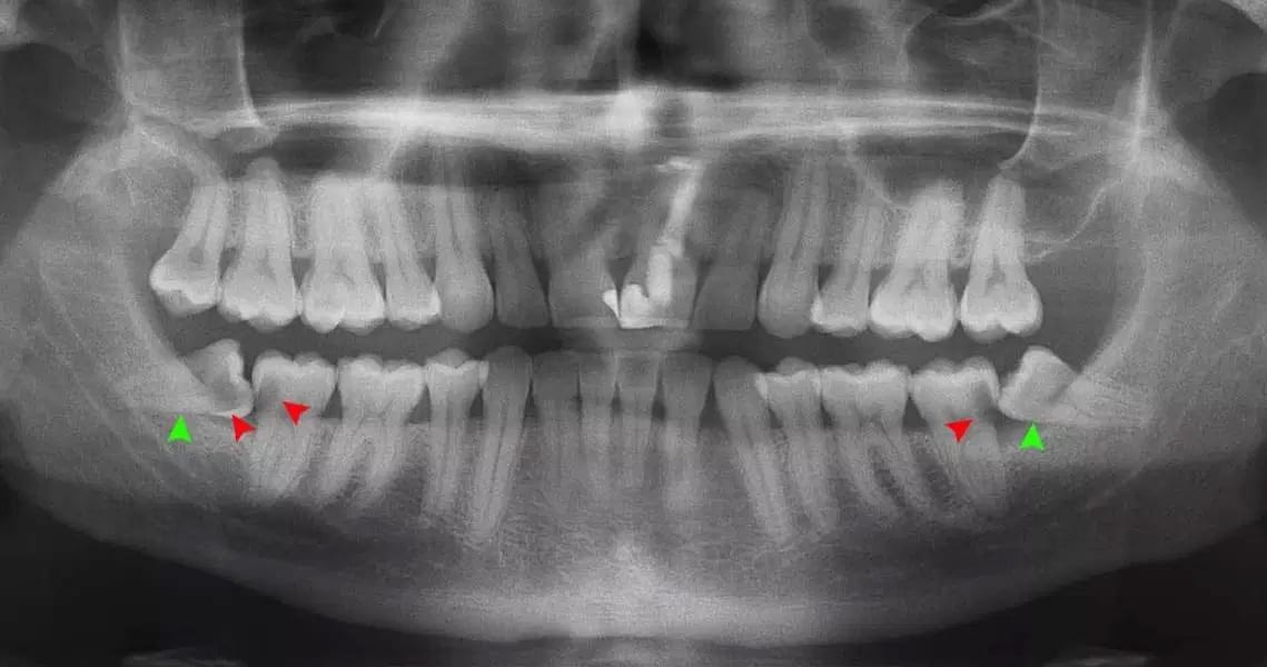 wisdom teeth image An x-ray shows impacted wisdom teeth that require removal.