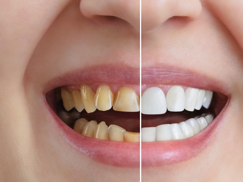 What is Teeth Whitening? Anchorage Family Dentists Mint Dental of
