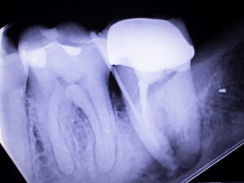 x-ray of a tooth in need of a root canal