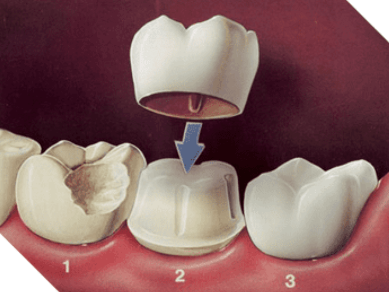 Cosmetic dental crowns enhance your smile aesthetics. Schedule a consultation today