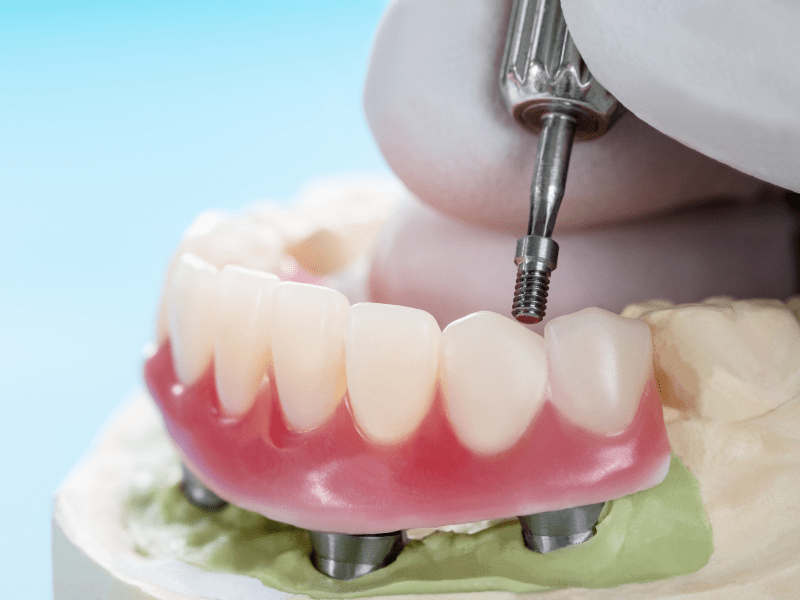 Mint Dental makes Implant-supported dentures easy and affordable