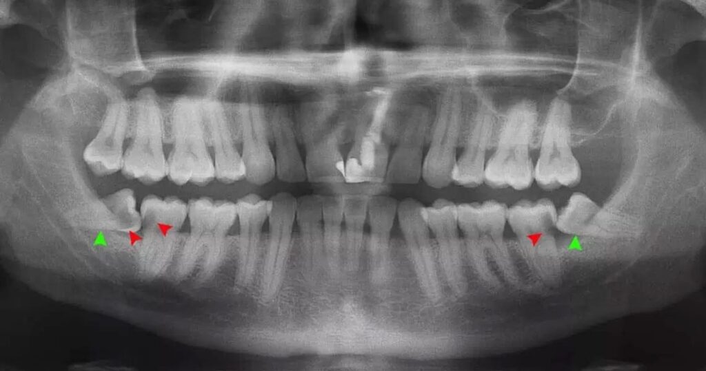 X-ray image showing impacted wisdom teeth due for extraction