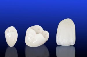 dental crowns - everything you want to know