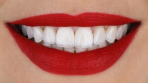 veneers versus crowns