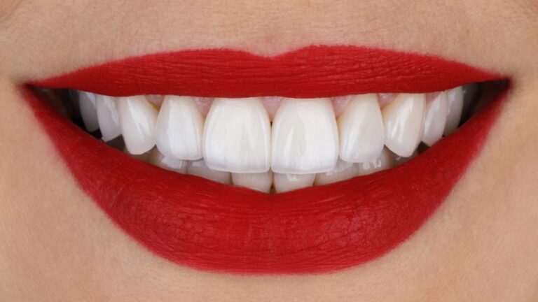 veneers versus crowns