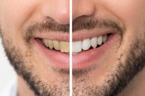 best teeth whitening remedies